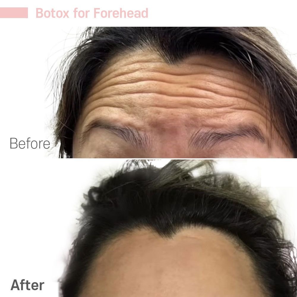 Botox for Forehead — before and after at nūri aesthetics