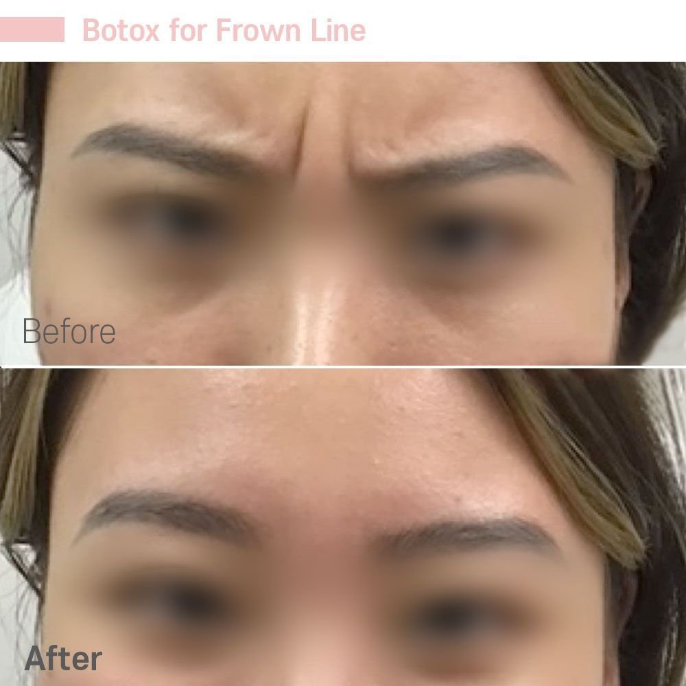 Botox for Frown — before and after at nūri aesthetics