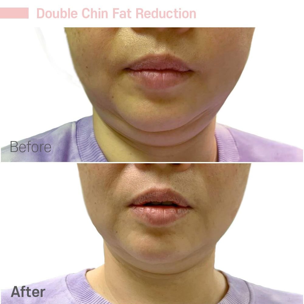Double Chin Fat Reduction 2 — before and after at nūri aesthetics