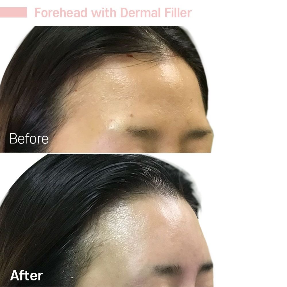 Forehead 4 — before and after at nūri aesthetics
