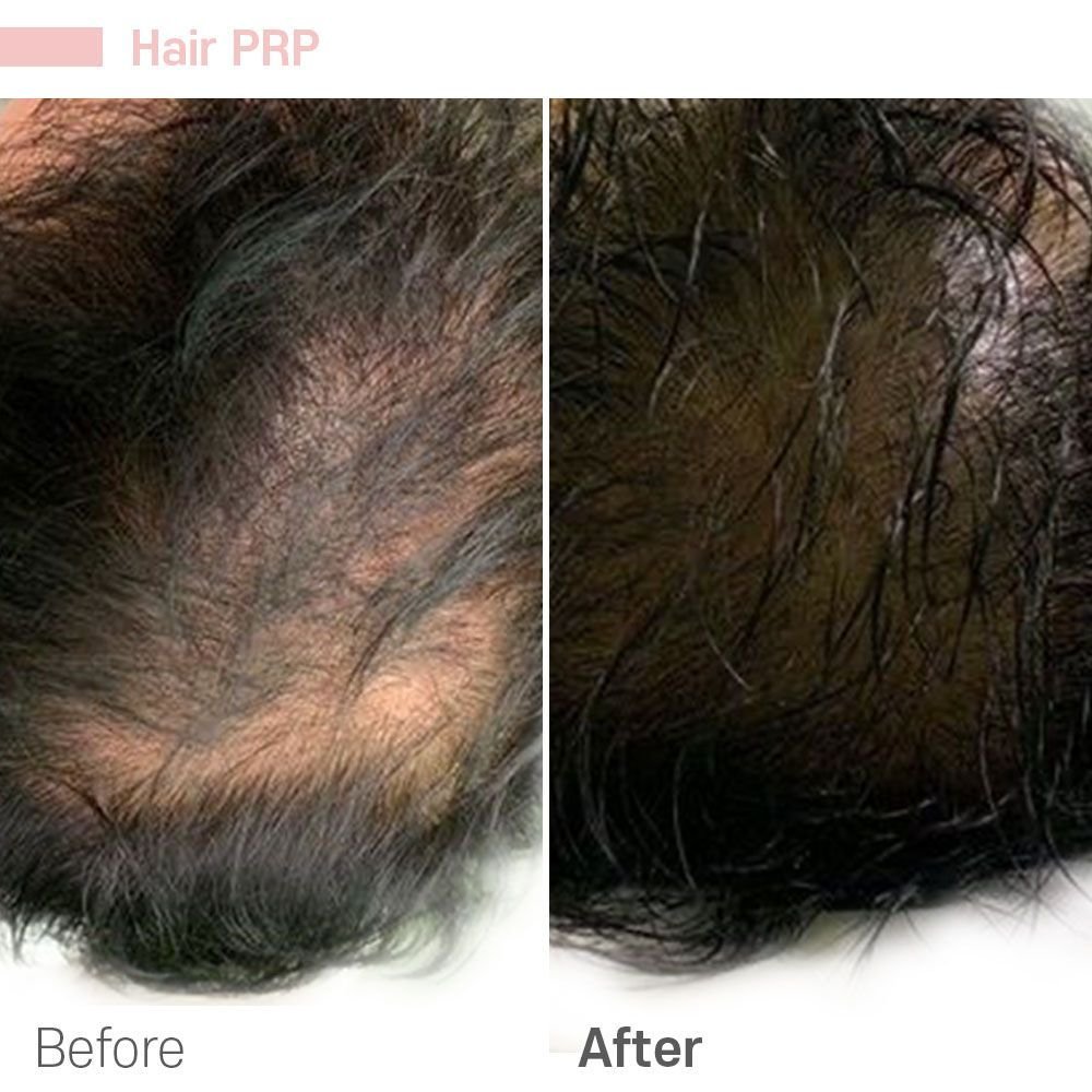 Hair PRP 2 — before and after at nūri aesthetics
