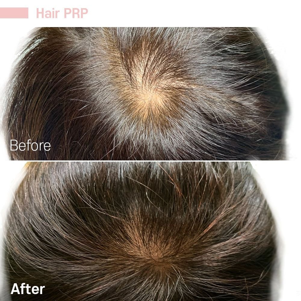 Hair PRP 3 — before and after at nūri aesthetics