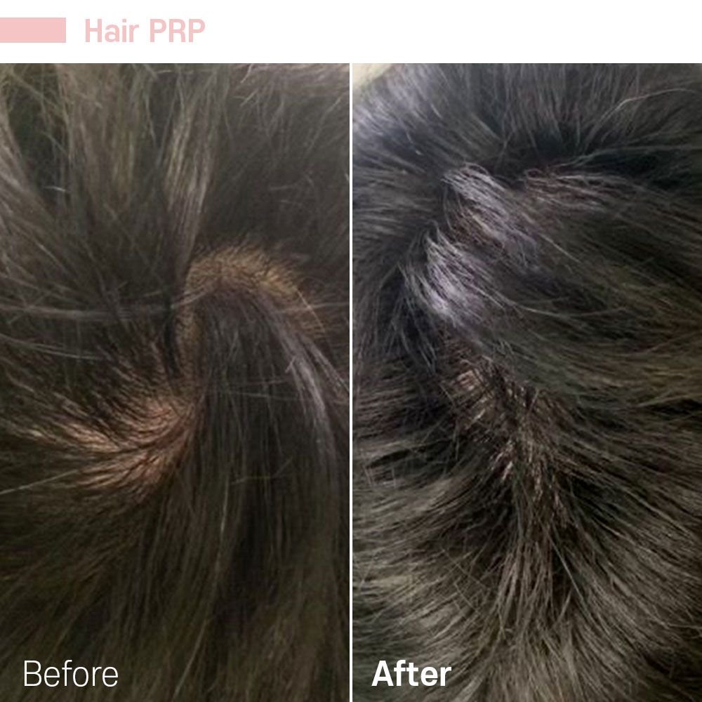 Hair PRP — before and after at nūri aesthetics