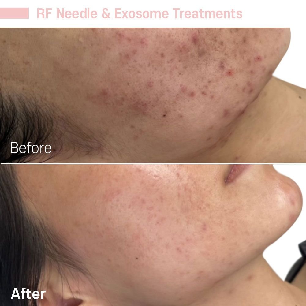 IMG_0595 — before and after at nūri aesthetics