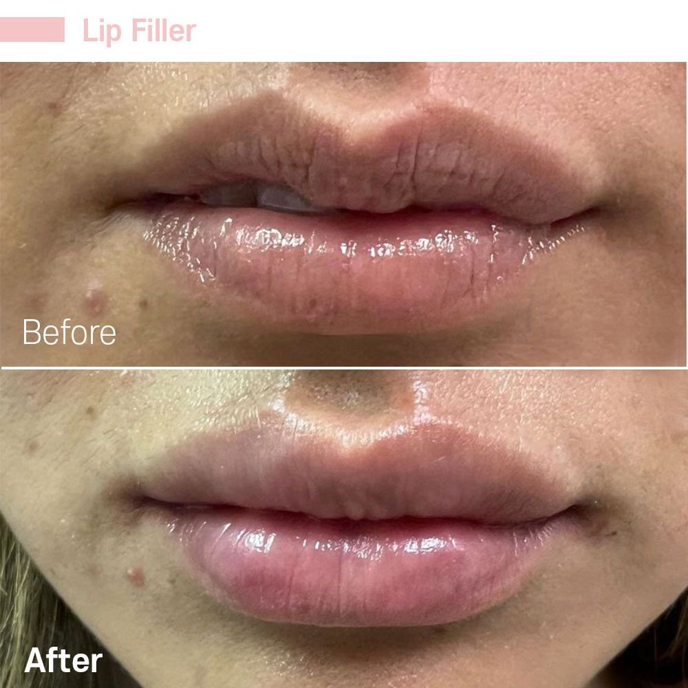 IMG_0610 — before and after at nūri aesthetics
