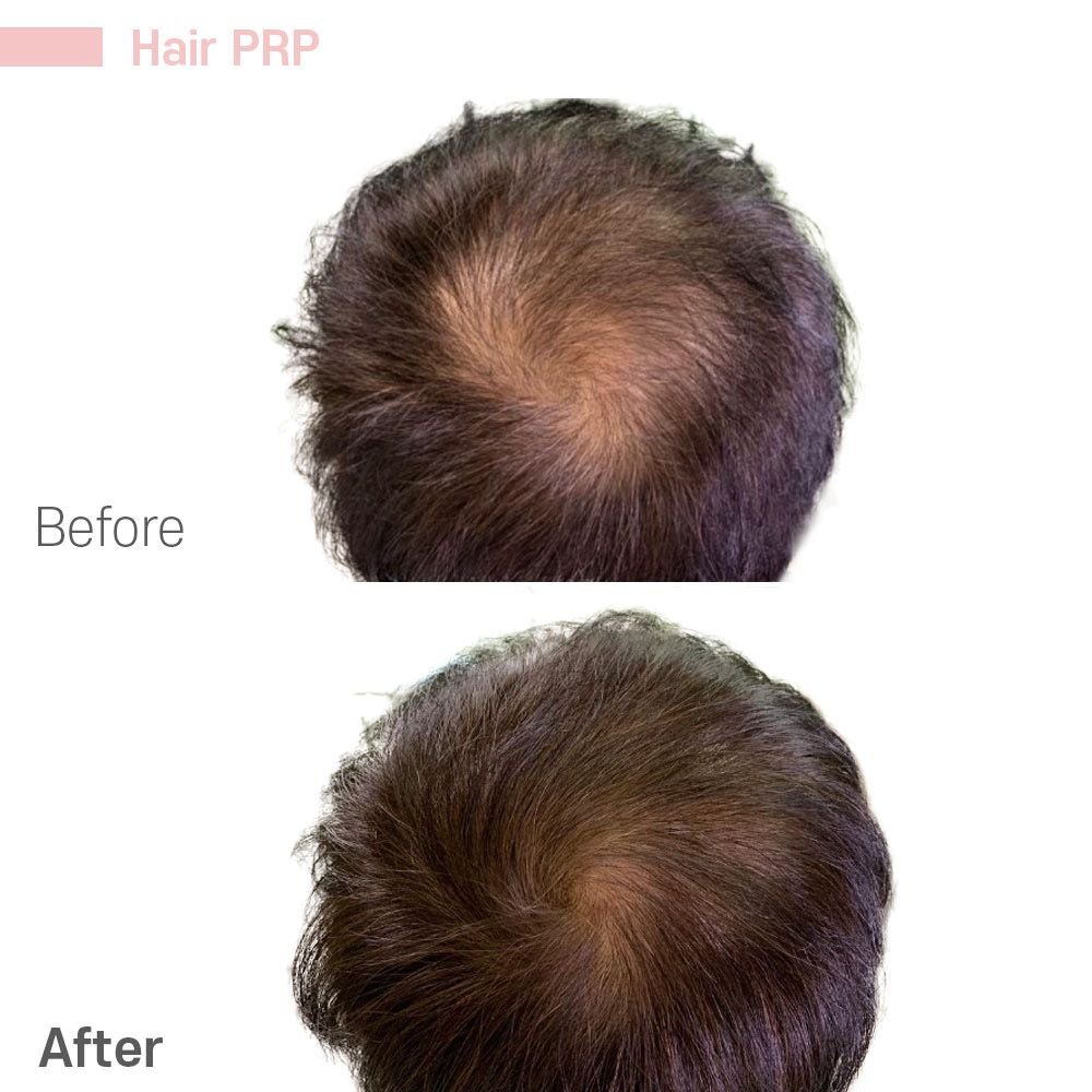 IMG_0631 — before and after at nūri aesthetics