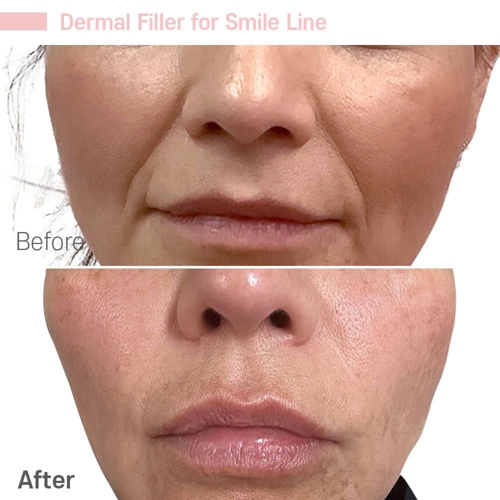 IMG_0634 — before and after at nūri aesthetics
