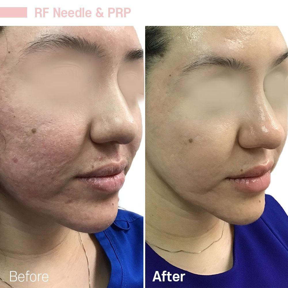 IMG_0638 — before and after at nūri aesthetics
