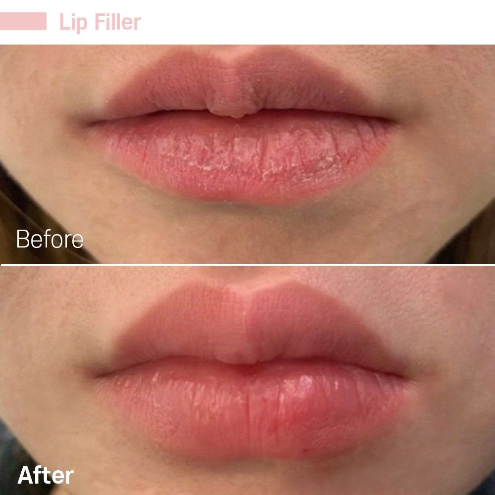 IMG_0754 — before and after at nūri aesthetics