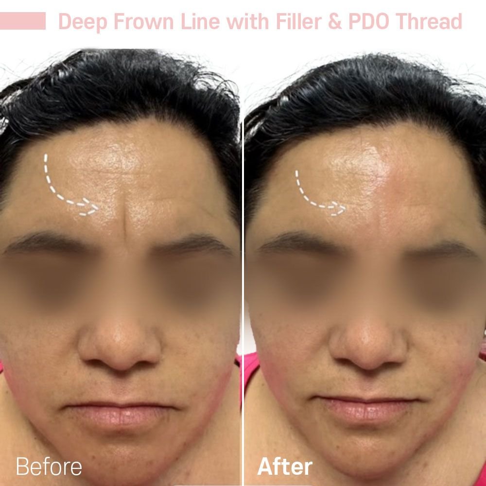 IMG_7851 — before and after at nūri aesthetics