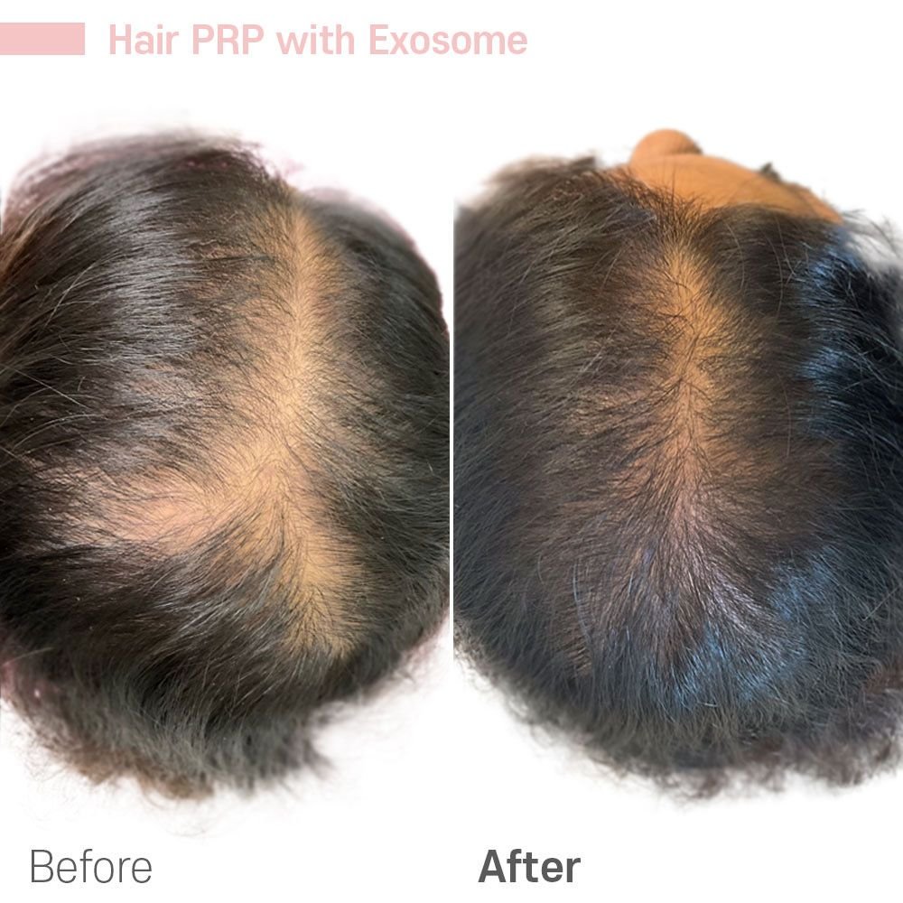 IMG_7852 — before and after at nūri aesthetics