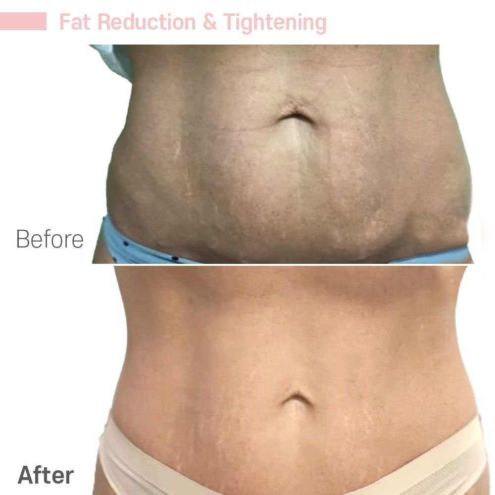 Inmode Weight Loss — before and after at nūri aesthetics