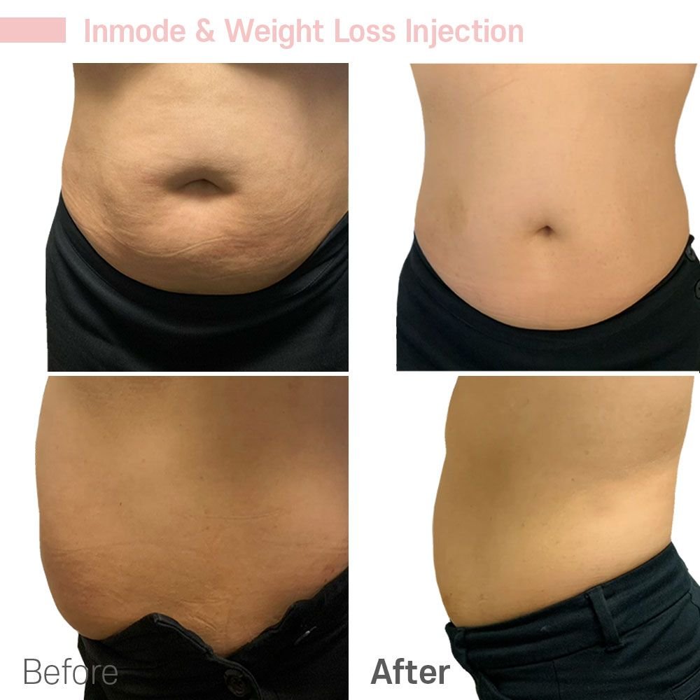 Inmode Weight Loss Injection — before and after at nūri aesthetics