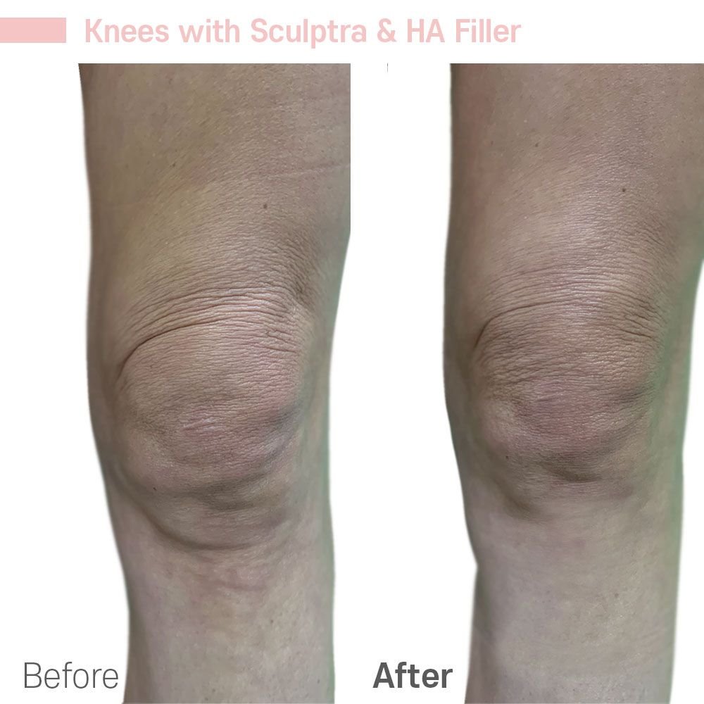 Knees — before and after at nūri aesthetics